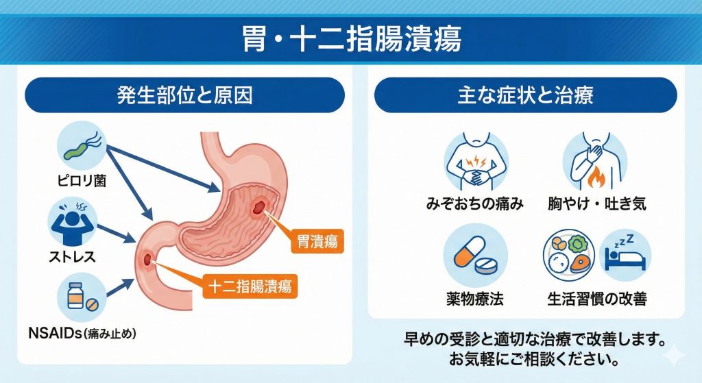 胃・十二指腸潰瘍（い・じゅうにしちょう かいよう） | 千里丘内視鏡